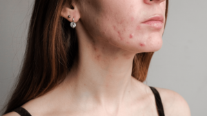 How Vitamin D Can Help Manage Acne