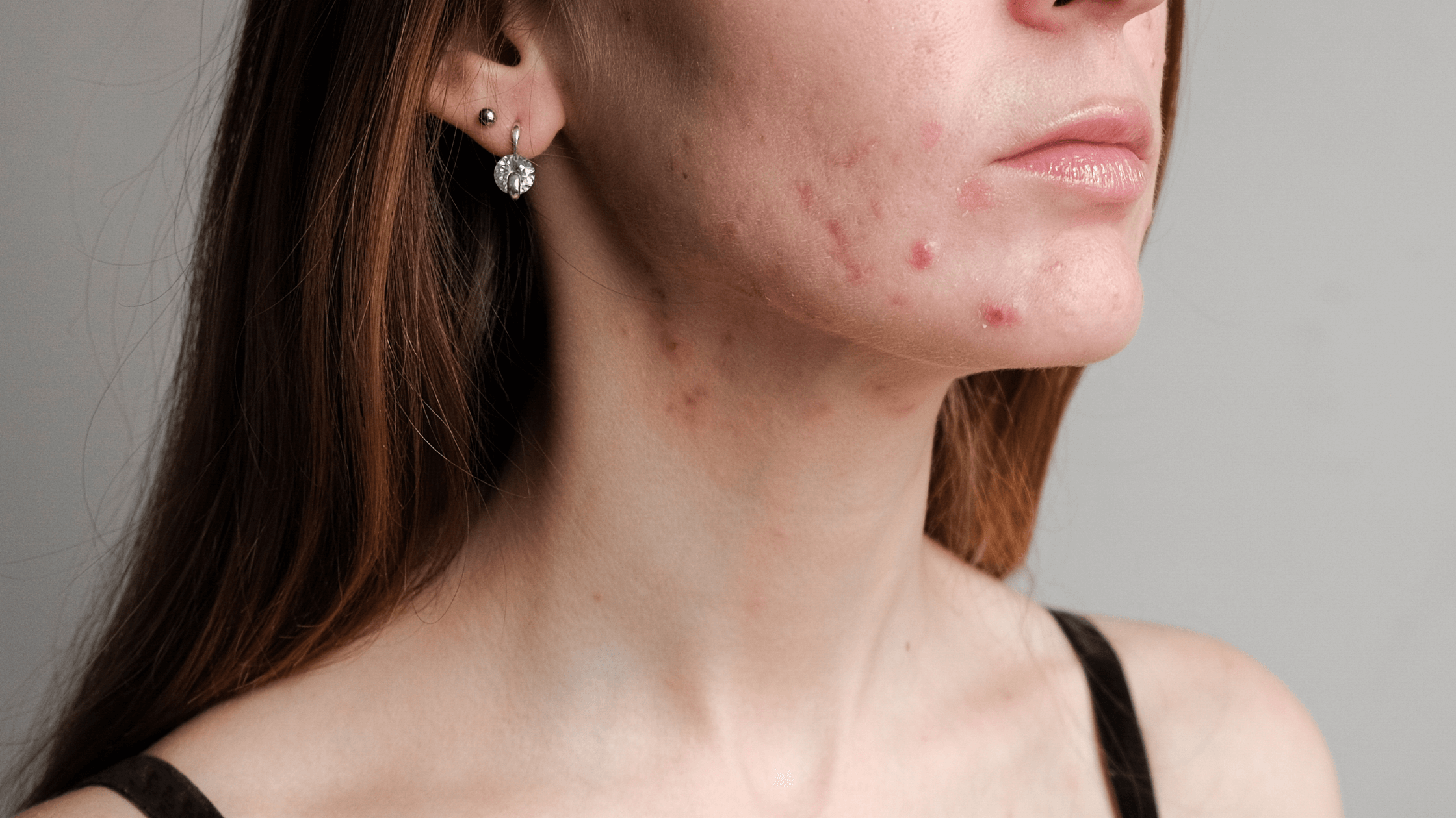 How Vitamin D Can Help Manage Acne