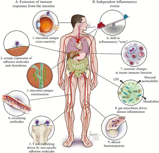 Diagram showing the external manifestations of Crohn's disease