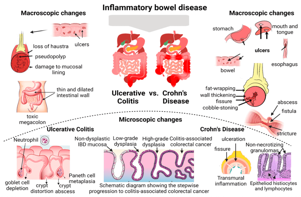 Infographic demonstrating the progression of inflammatory bowel disease