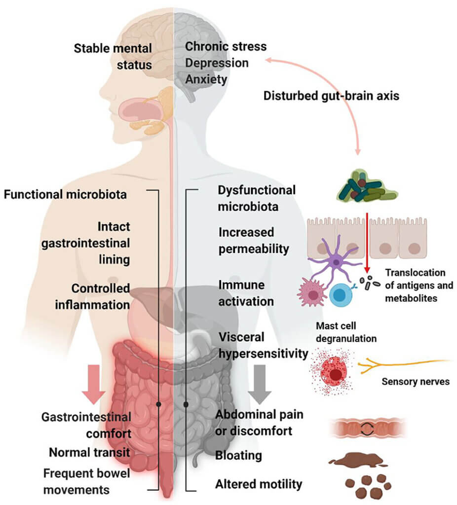 Infographic showing common risk factors of irritable bowel syndrome