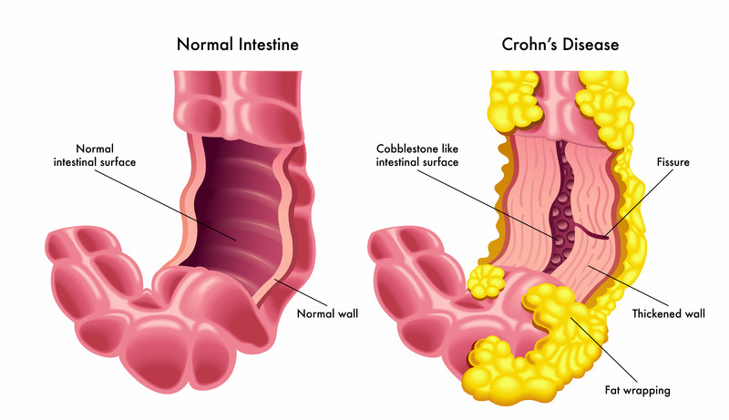 Diagram showing the difference between a normal intestine and an Intestine Affected By Crohns Disease