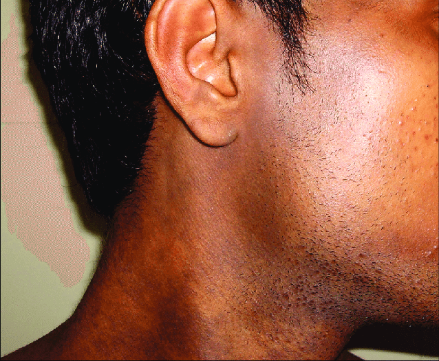 Lichen Planus Pigmentosus Starts With Lesions On Face