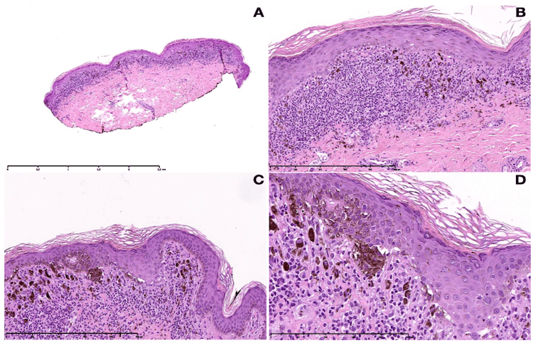 Dermatopathology of lichen planus