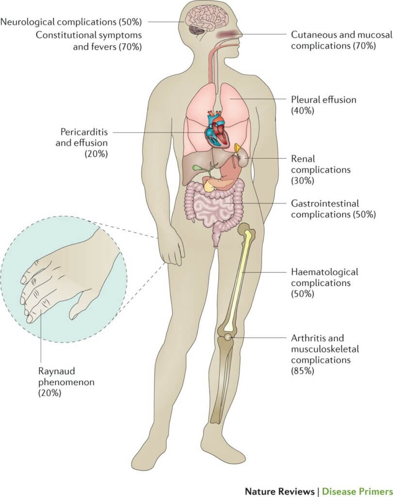 A detailed diagram demonstrating the basics of lupus erythematosus.